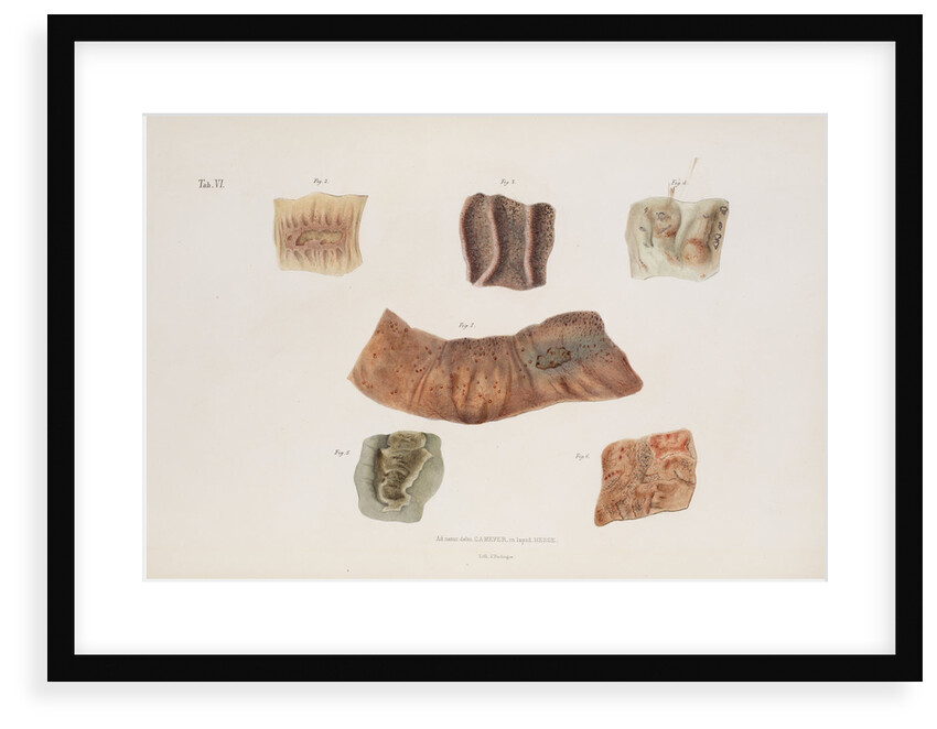 Alterations caused by cholera in the intestinal mucous membrane by d'Harlingue