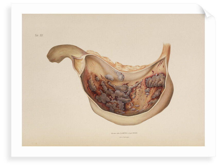 Effect of diphtheric-cholera on the mucous membrane of the stomach by d'Harlingue