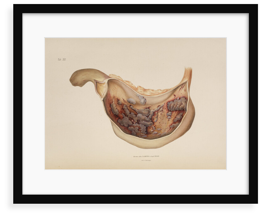 Effect of diphtheric-cholera on the mucous membrane of the stomach by d'Harlingue