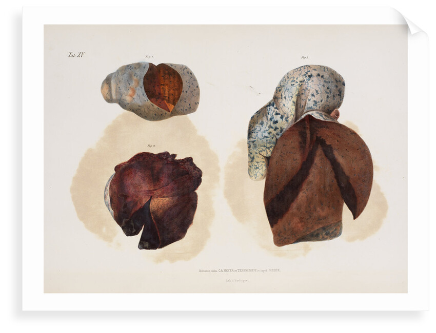 Changes in lung tissue occurring in cases of cholera by d'Harlingue