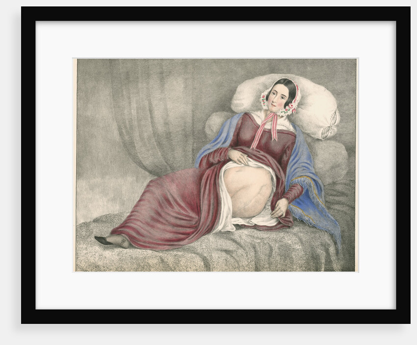 Portrait of Elizabeth Powis showing a leg amputation by Leonard