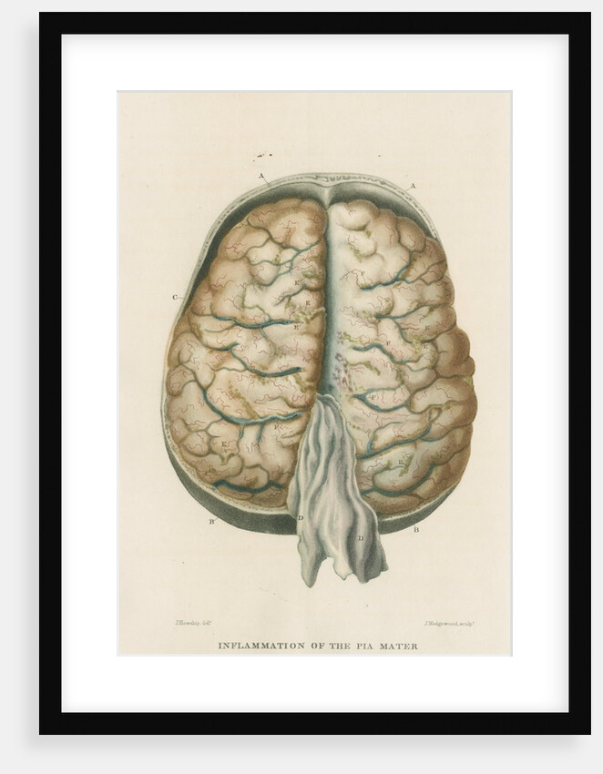 'Inflammation of the pia mater and tunica arachnoides' by J Wedgewood