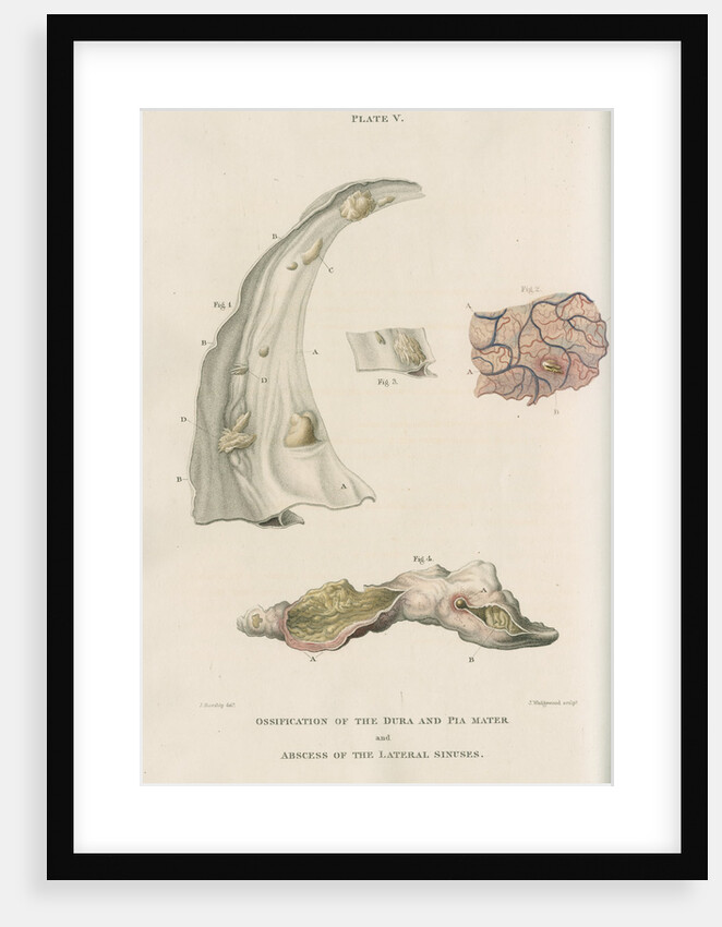 'Ossification of the dura and pia mater' by J Wedgewood