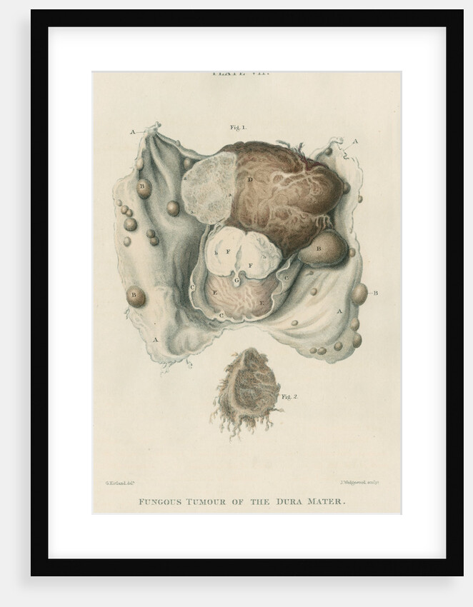 'Fungous tumour of the dura mater' by J Wedgewood