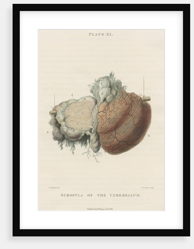 'Scrofula of the cerebellum' by J Stewart senior