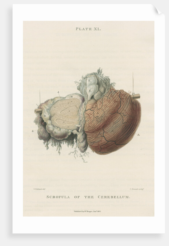 'Scrofula of the cerebellum' by J Stewart senior