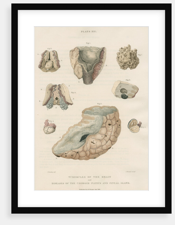 'Tubercles of the brain' by J Stewart senior