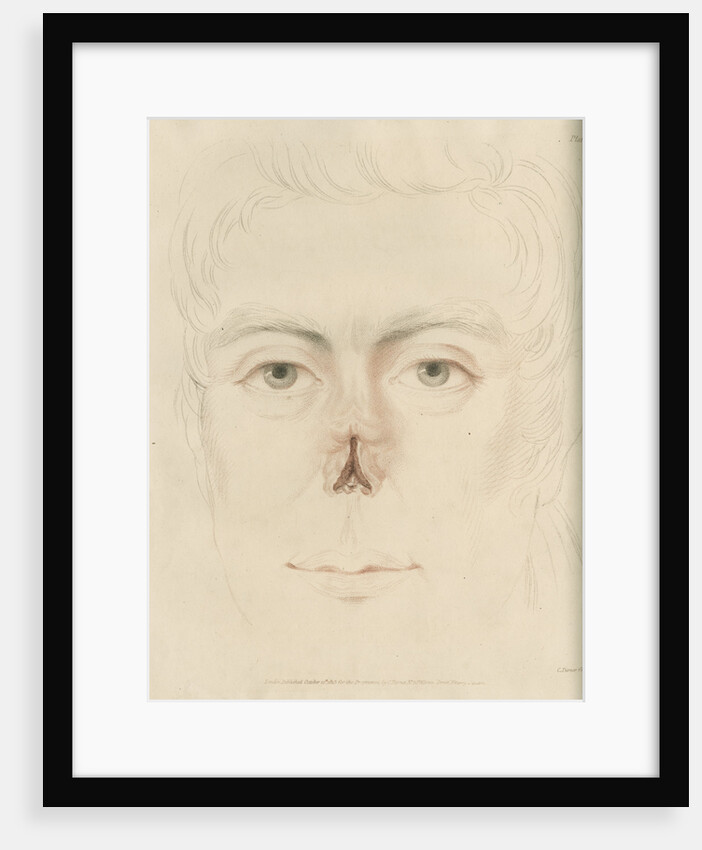 A candidate for a nose replacement by Charles Turner