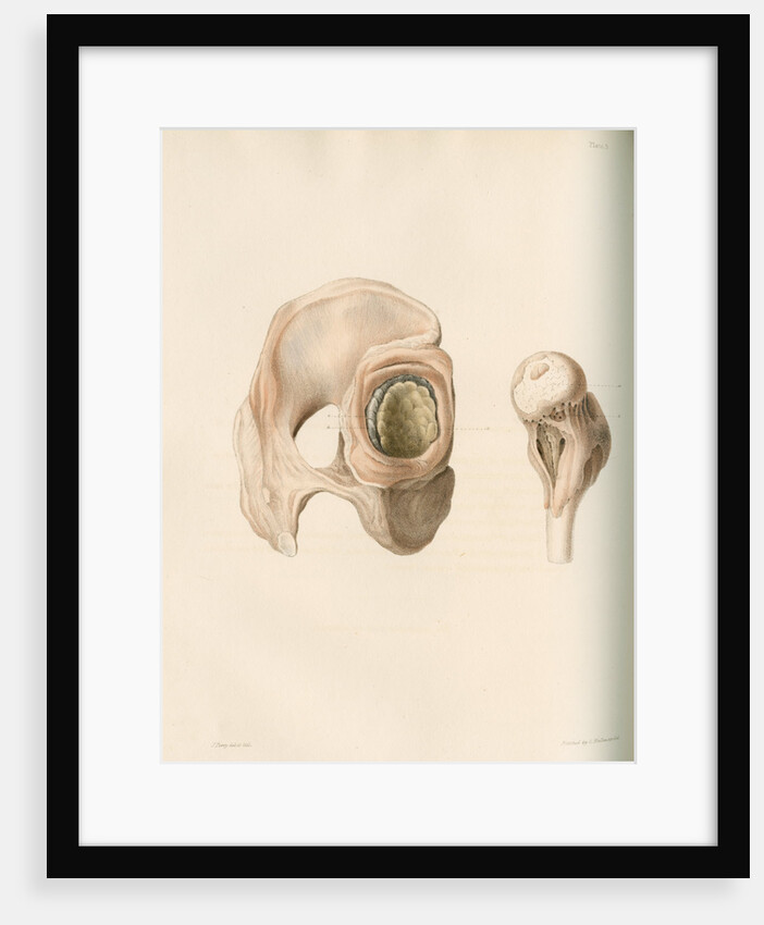 Hip and femur by G Hallmandel