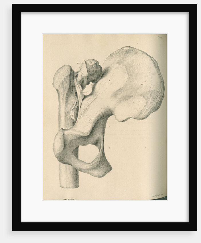 Posterior view of a left dislocated femur and hip bone by J Perry