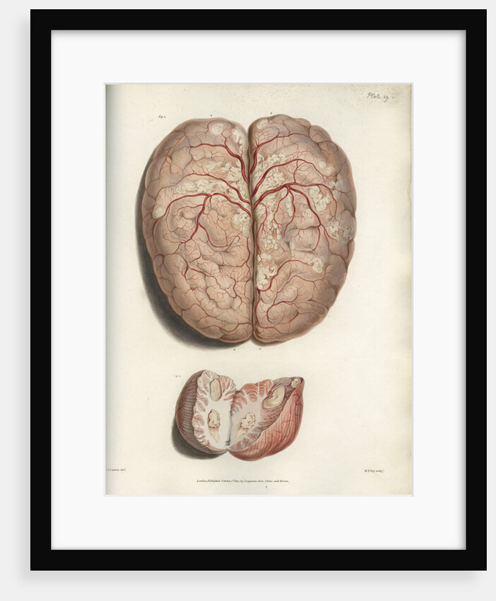 'Scrofulous tubercles in the brain' by C J Canton