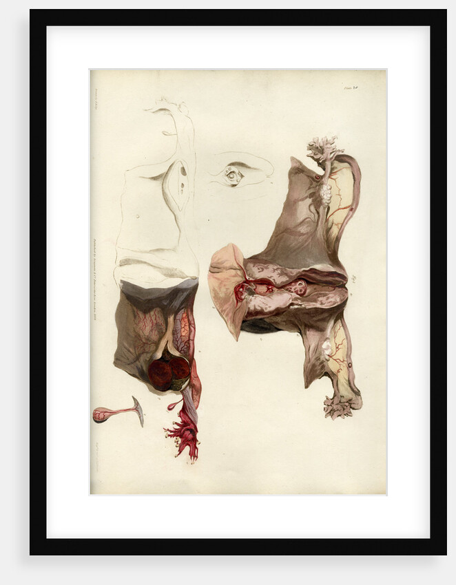 'Diseases of the uterus giving rise to excessive nervous irritation' by C J Canton