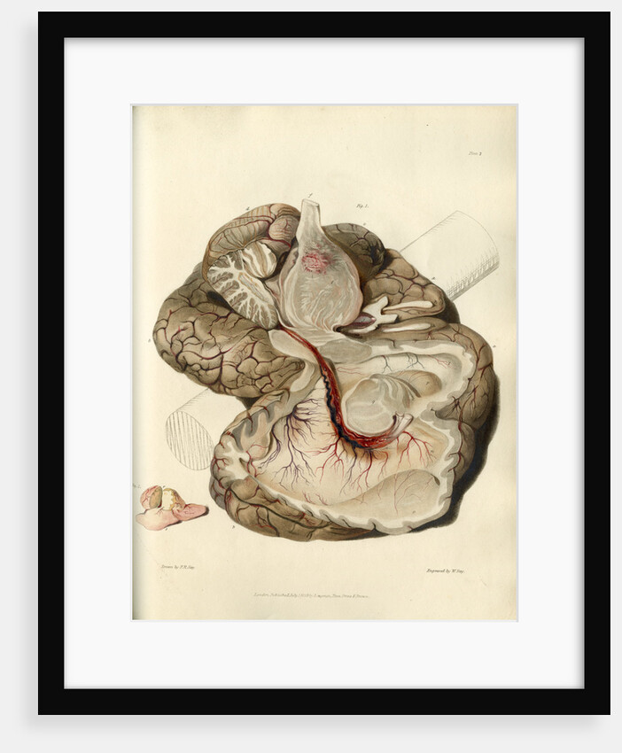 'Tumour of the pons Varolii' by William Say