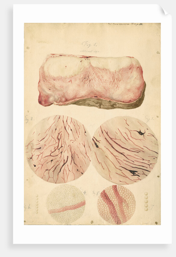 Tumor with human blood lymph cells by Franz Andreas Bauer