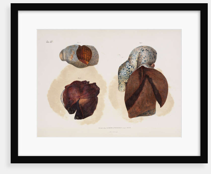 Changes in lung tissue occurring in cases of cholera by d'Harlingue