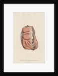 'Inflammation of the dura mater' by J Wedgewood
