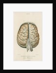 'Inflammation of the pia mater and tunica arachnoides' by J Wedgewood