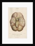 'Inflammation of the pia mater and tunica arachnoides' by J Wedgewood