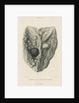'Tumours of the dura mater' by J Wedgewood