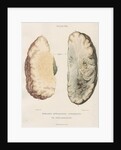 'Inflammation of the brain' by J Wedgewood