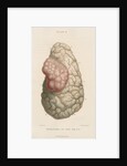 'Haematoma of the brain' by J Stewart senior