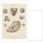 'Tubercles of the brain' by J Stewart senior