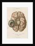 'Encysted tumour of the brain' by J Wedgewood