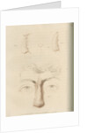 A successful nose replacement using the Indian Method by Charles Turner