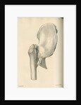 Lateral view of anchylosis of the right femur with the hip bone by J Perry