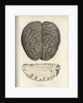 'Extreme cerebral congestion' by William Thomas Fry