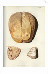 'Effects of jaundice on the brain and its membranes' by William Thomas Fry