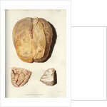 'Effects of jaundice on the brain and its membranes' by William Thomas Fry
