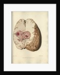 'Cyst in the brain' by William Say