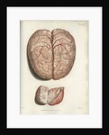 'Scrofulous tubercles in the brain' by C J Canton