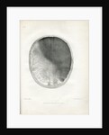 'Epilepsy' by Godefroy Engelmann