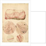 Tumor with human blood lymph cells by Franz Andreas Bauer