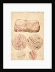 Tumor with human blood lymph cells by Franz Andreas Bauer