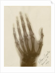 X-ray photograph of the hand of William Crookes by Alan Archibald Campbell Swinton